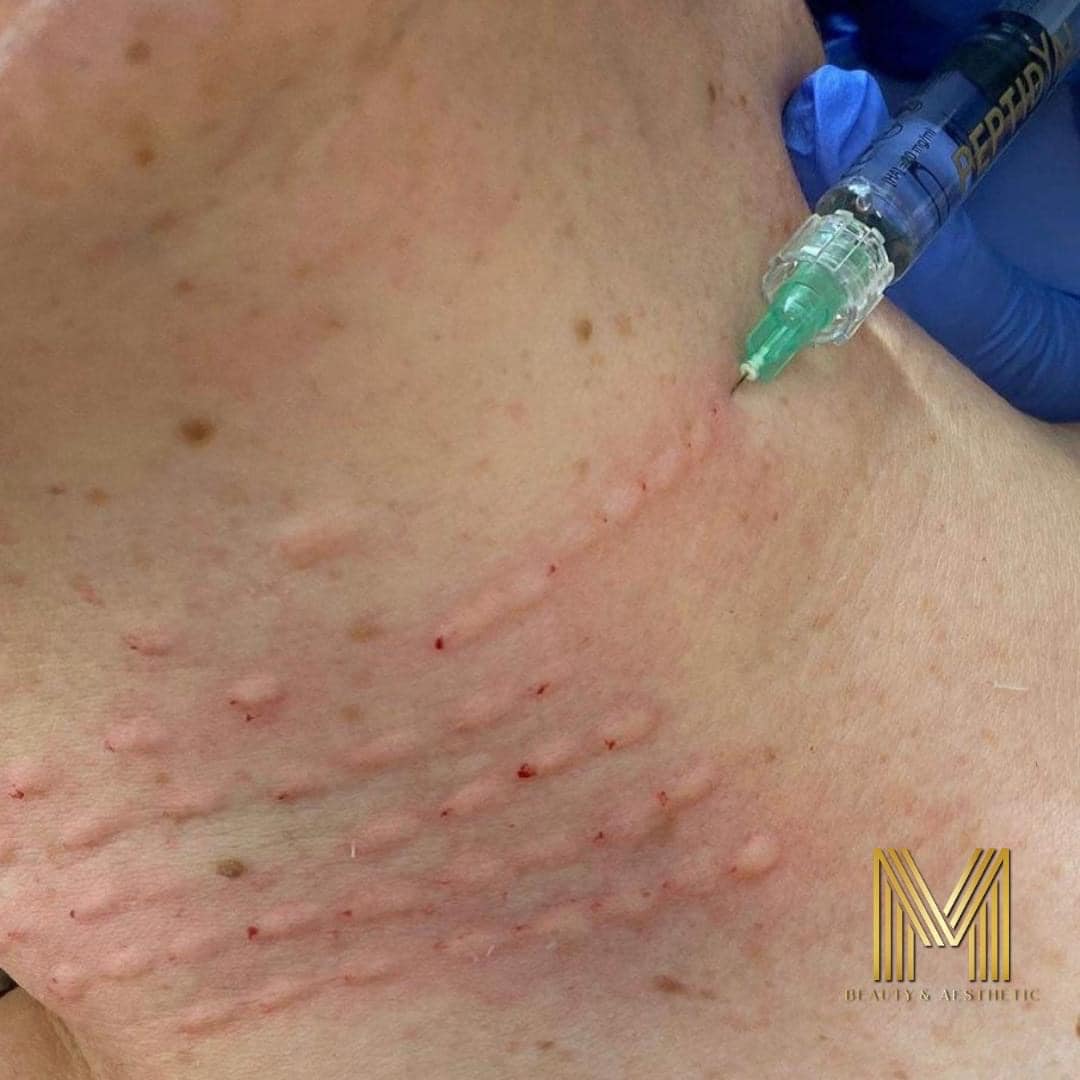 neck needle