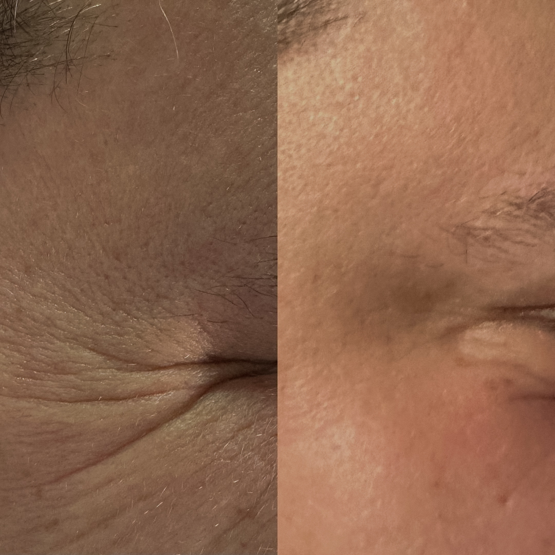 wrinkle